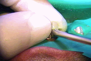 金属のかぶせものを除去する瞬間2017.04.15.gif