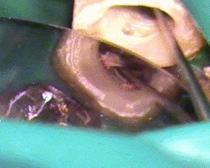 ガッタパーチャをさわると膿が出てくる2017.06.29.gif