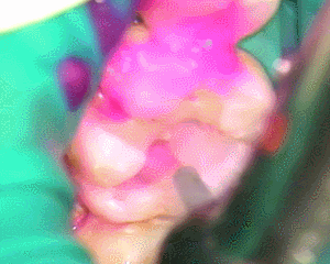 左下６インレー除去した内部をう蝕検知液で染色2018.04.04.gif