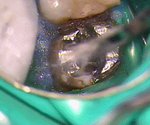 チタンのメタルコア除去3.gif