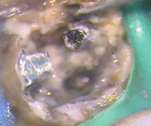 チタンのメタルコア除去5.gif