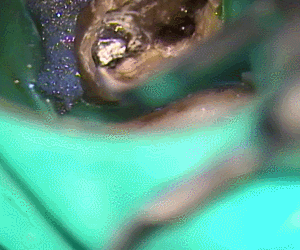 チタンのメタルコア除去6.gif