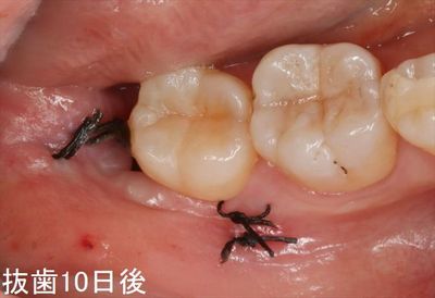 IMG_5316抜歯10日後R26.JPG