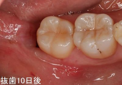 IMG_5317抜歯後10日_R26.JPG